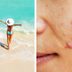 Yes, Your Acne Is Worse in the Summer—Here's How You Can Get Rid of It
