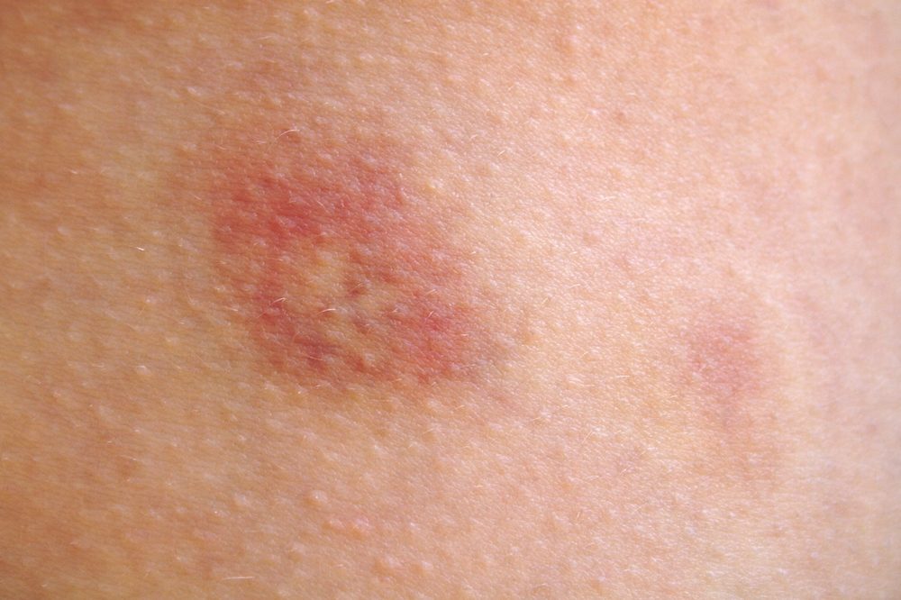 A skin welt 