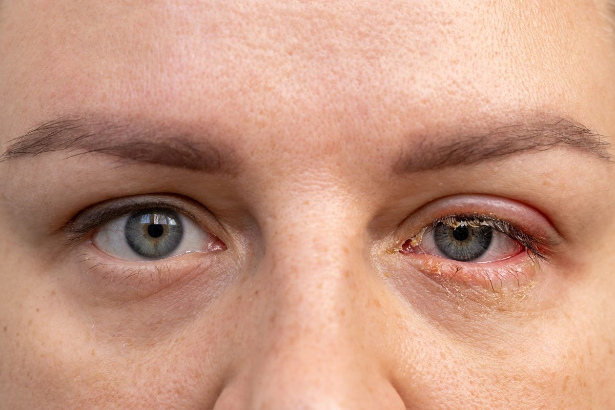 What Conditions Are Commonly Misdiagnosed As Pink Eye 