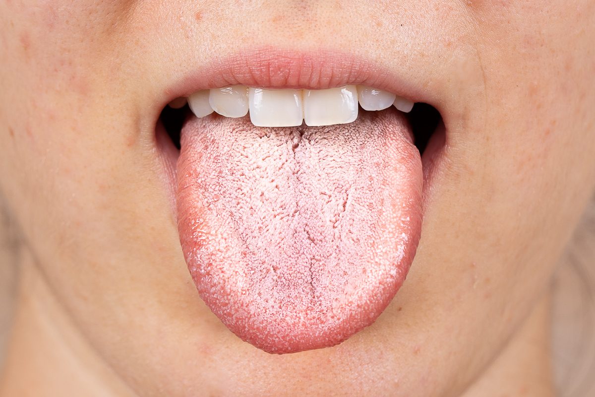 white patches on tongue