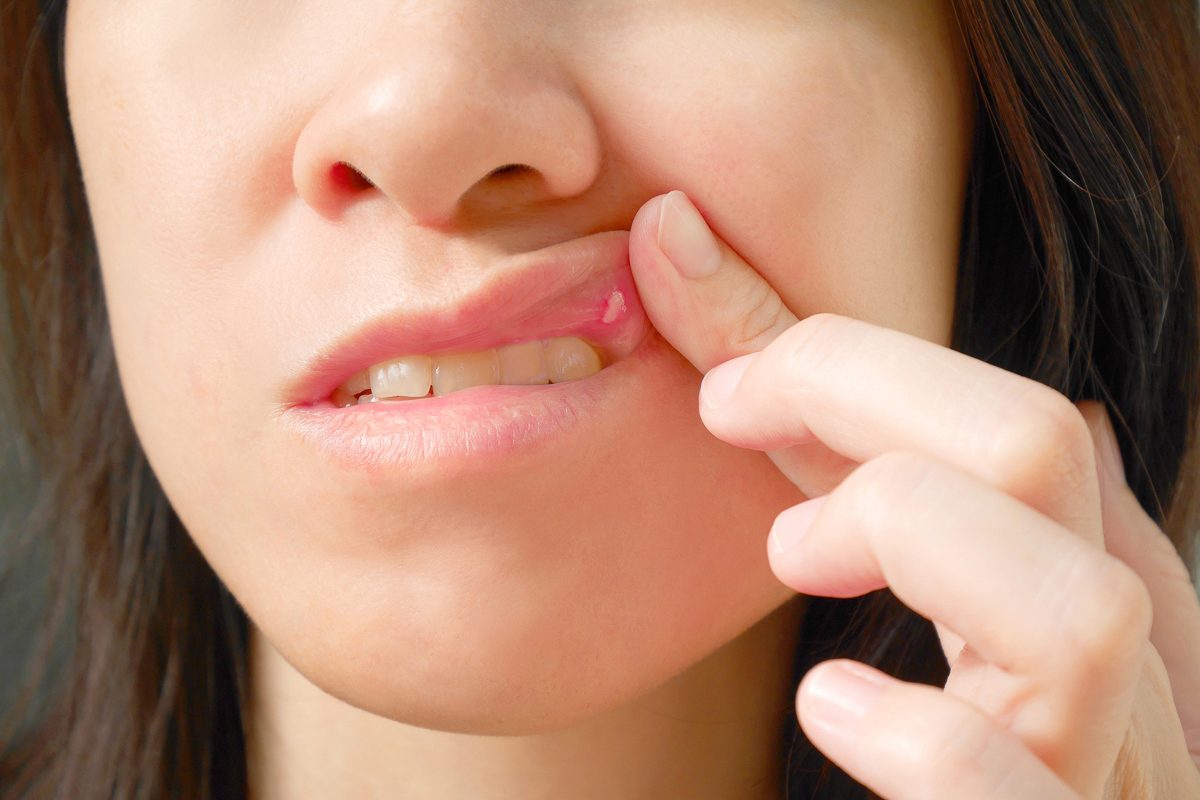 canker sore 
