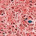 How I Knew I Had Chronic Lyme Disease: A Patient's Painful Lessons and an Expert Doctor's Thoughts
