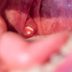 'Here's How I Knew I Had Tonsil Stones': How an Oddly Common Annoyance Upended A Patient's Quality of Life