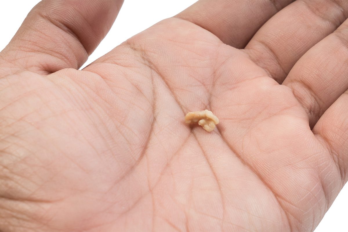 Here's How I Knew I Had Tonsil Stones Gettyimages 1026617044